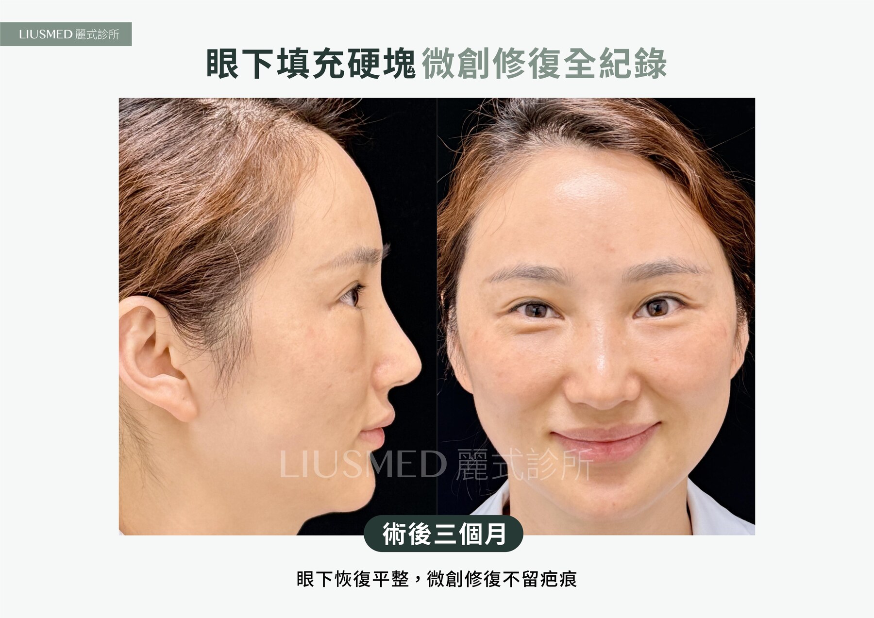 After - 眼下補脂結塊、再補增生劑又一塊——五年雙層硬塊，超音波定位後針孔取出