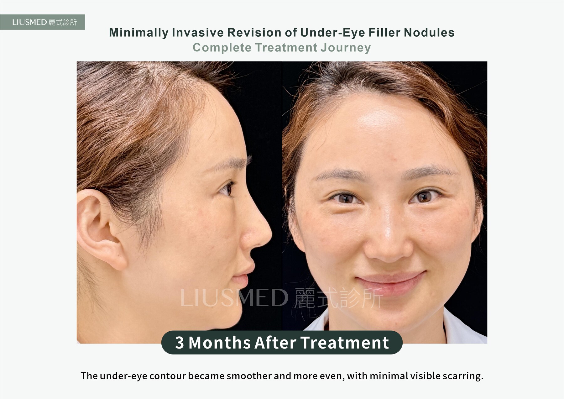 After - Fat Graft, Then a Collagen Stimulator: Two Stacked Under-Eye Nodules Removed Through a Pinhole