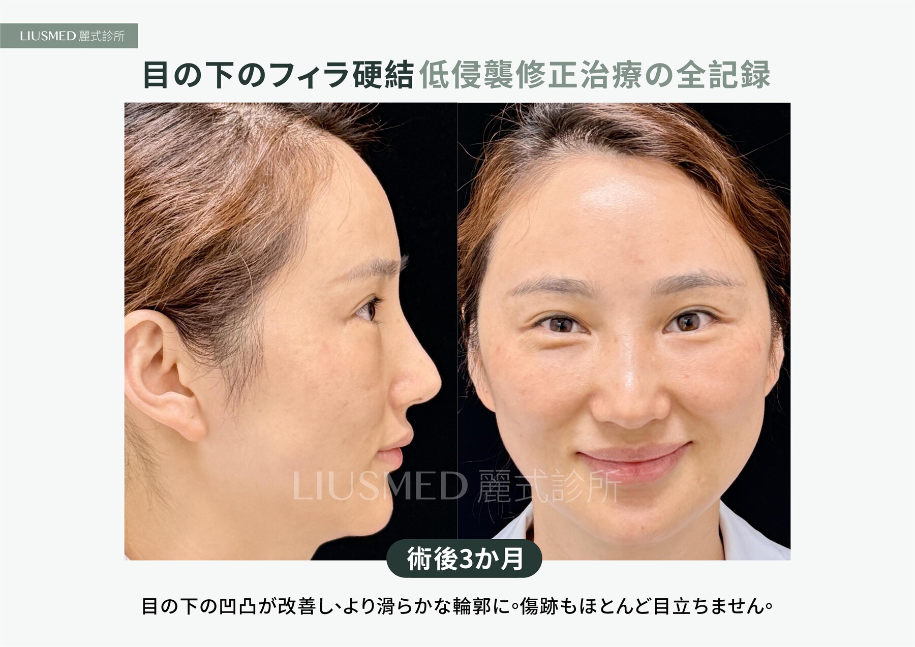 After - 目の下の脂肪注入でしこり、さらに刺激剤でもう一つ——5年越しの二層のしこりを超音波で位置決めし針穴から摘出