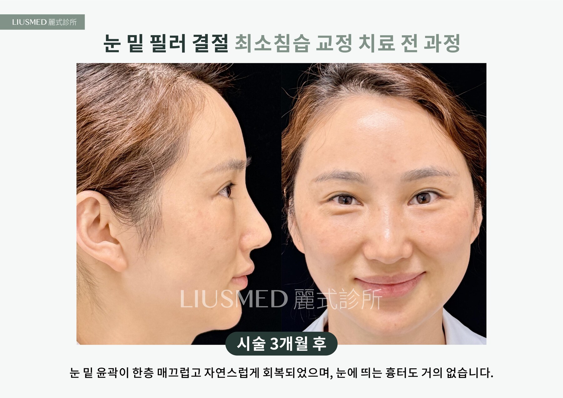 After - 눈밑 지방이식 멍울, 다시 자극제로 또 하나——5년 된 이중 멍울을 초음파로 확인 후 바늘구멍으로 제거