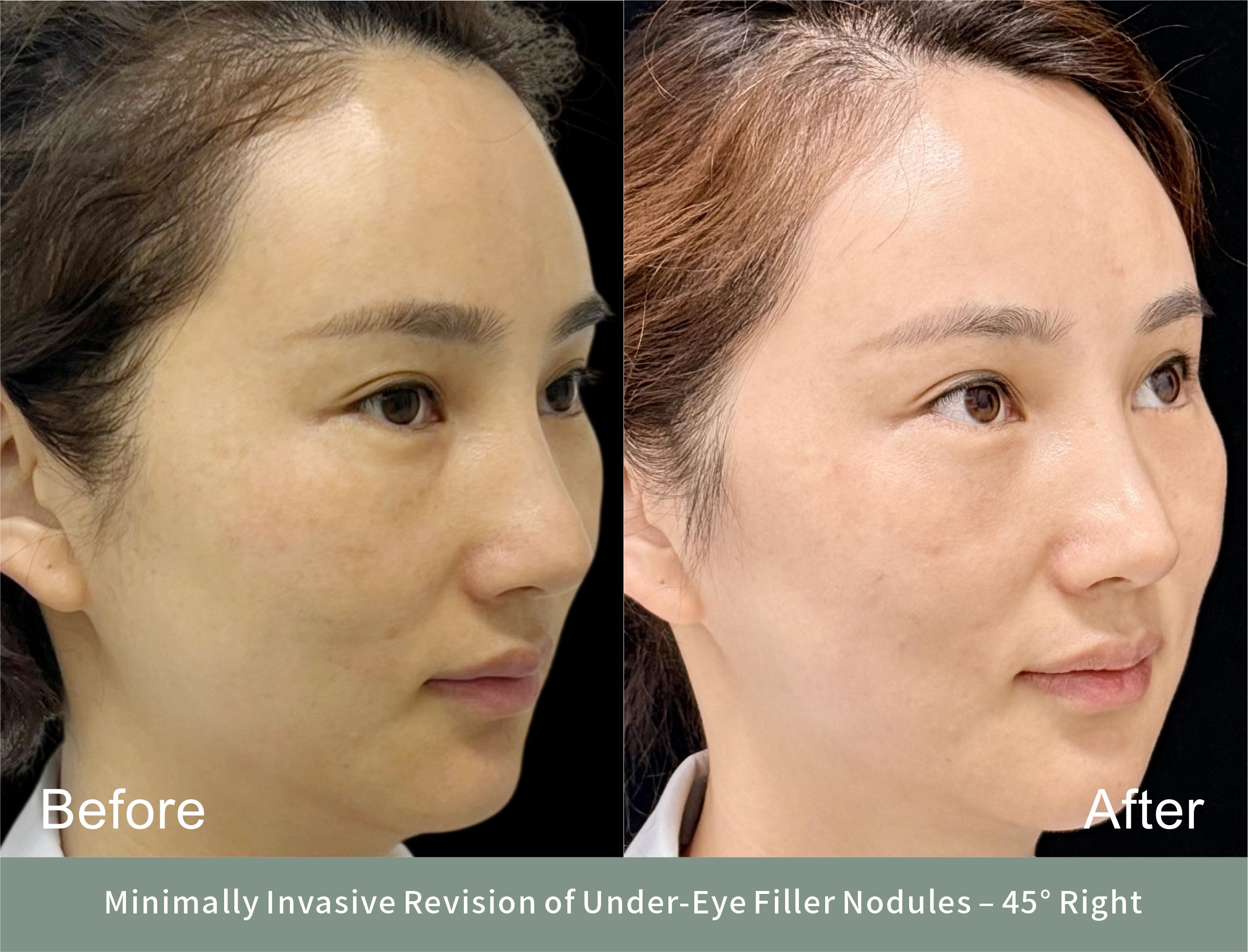 The same patient at 45° on the right — the side the nodules were on. An oblique view is where an under-eye step actually shows: the skin is thin enough that any difference in height becomes a shadow under raking light, while a straight-on frame tends to flatten it out. (Shared with the patient’s consent; images de-identified. Recovery varies by individual.)