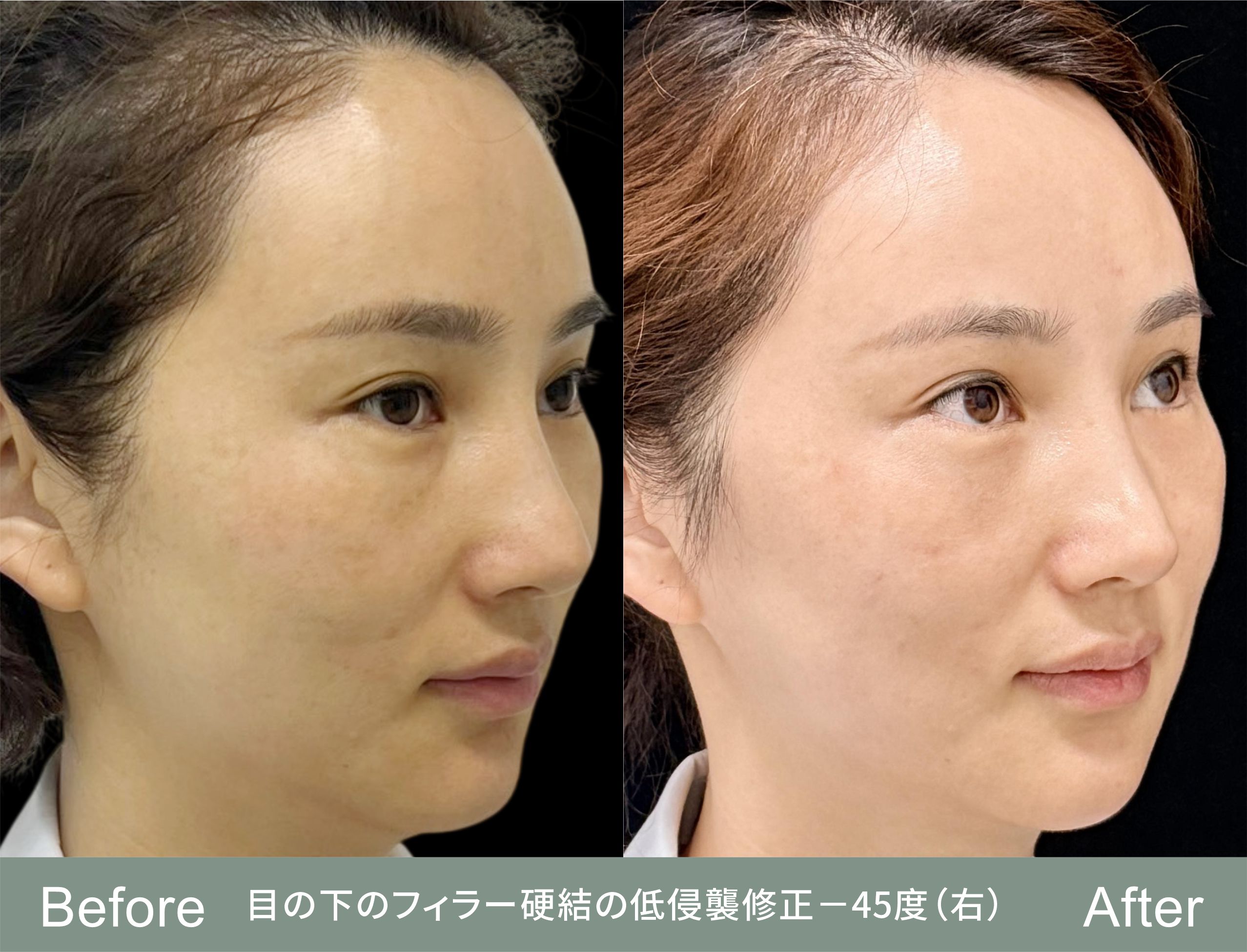 同じ患者さんの右斜め45度の対比——しこりはもともと右の目の下にありました。目の下の段差は斜めから見たときに最もよく分かります。皮膚が薄いぶん、わずかな高低差も斜めの光の下では影になり、正面では光でならされて見えにくくなるためです。 (ご本人の同意を得て共有、画像は匿名化済み。回復には個人差があります。)