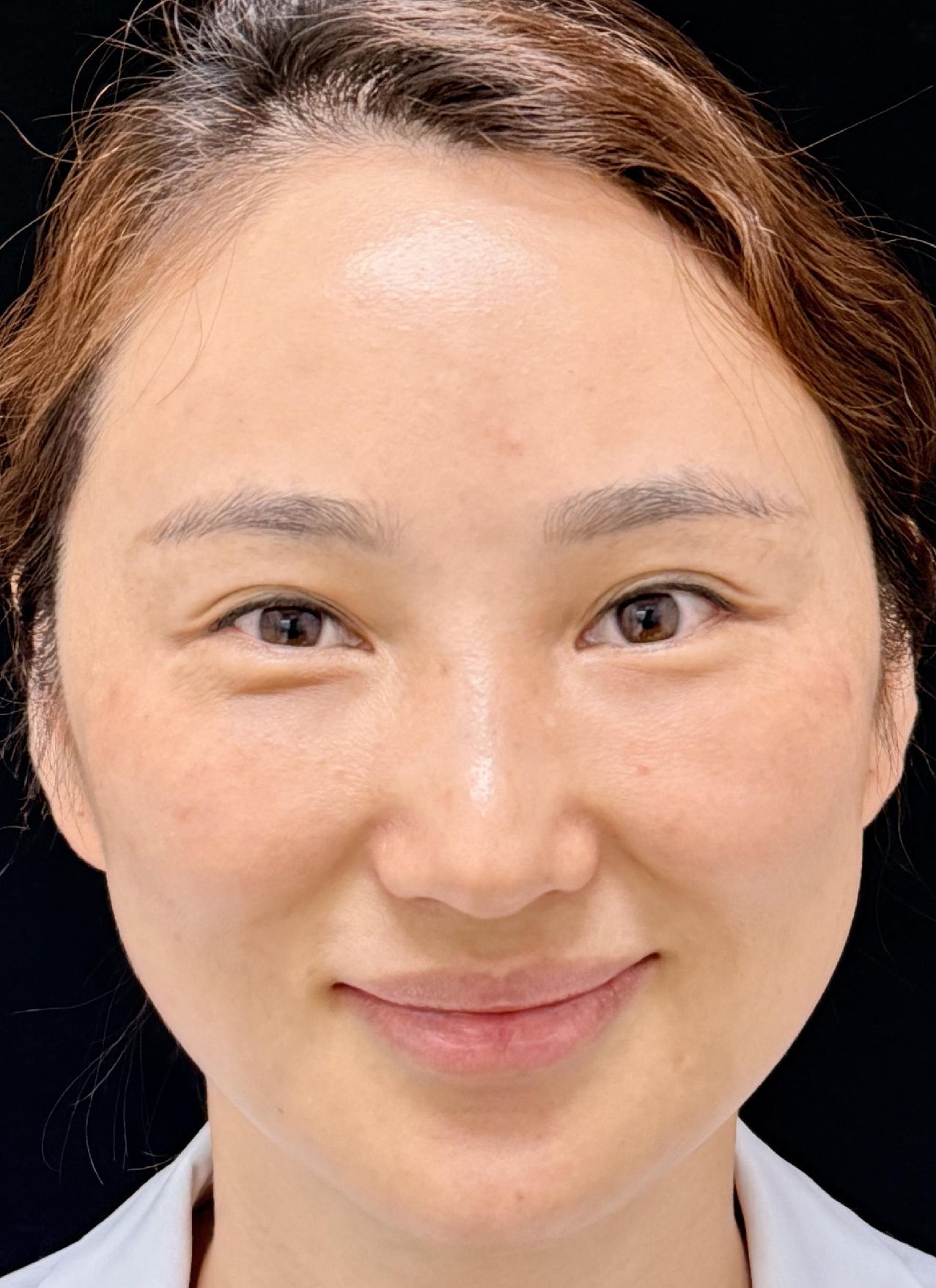 施術後 — 目の下の脂肪注入でしこり、さらに刺激剤でもう一つ——5年越しの二層のしこりを超音波で位置決めし針穴から摘出