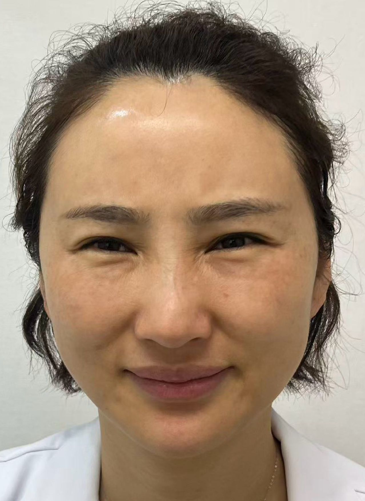 眼下補脂結塊、再補增生劑又一塊——五年雙層硬塊,超音波定位後針孔取出