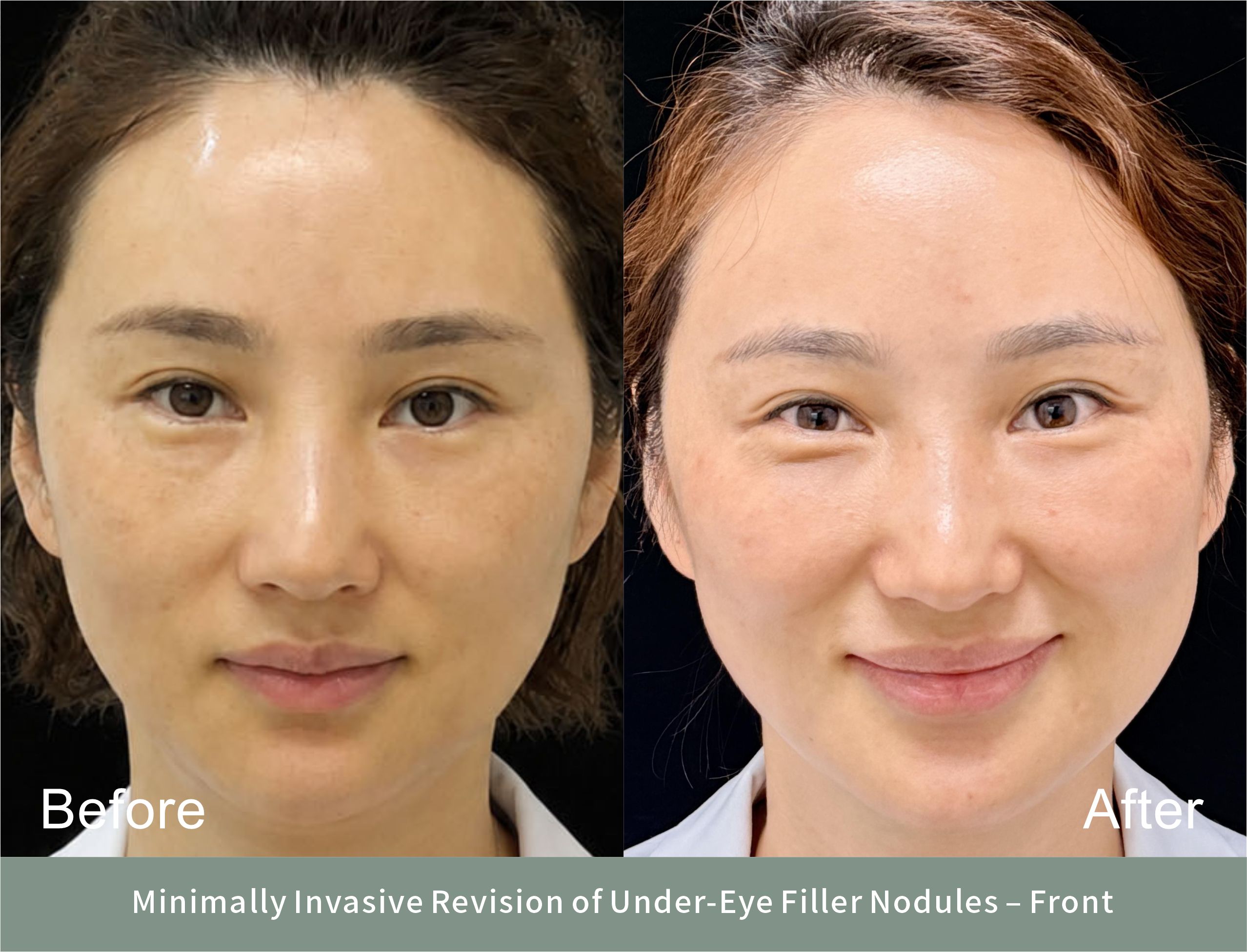 Before, and three months after — the same expression in both frames, so the under-eye contour is what changes. Smiling was the point: that is when the orbicularis pushed both nodules into relief. (Shared with the patient’s consent; images de-identified. Recovery varies by individual.)