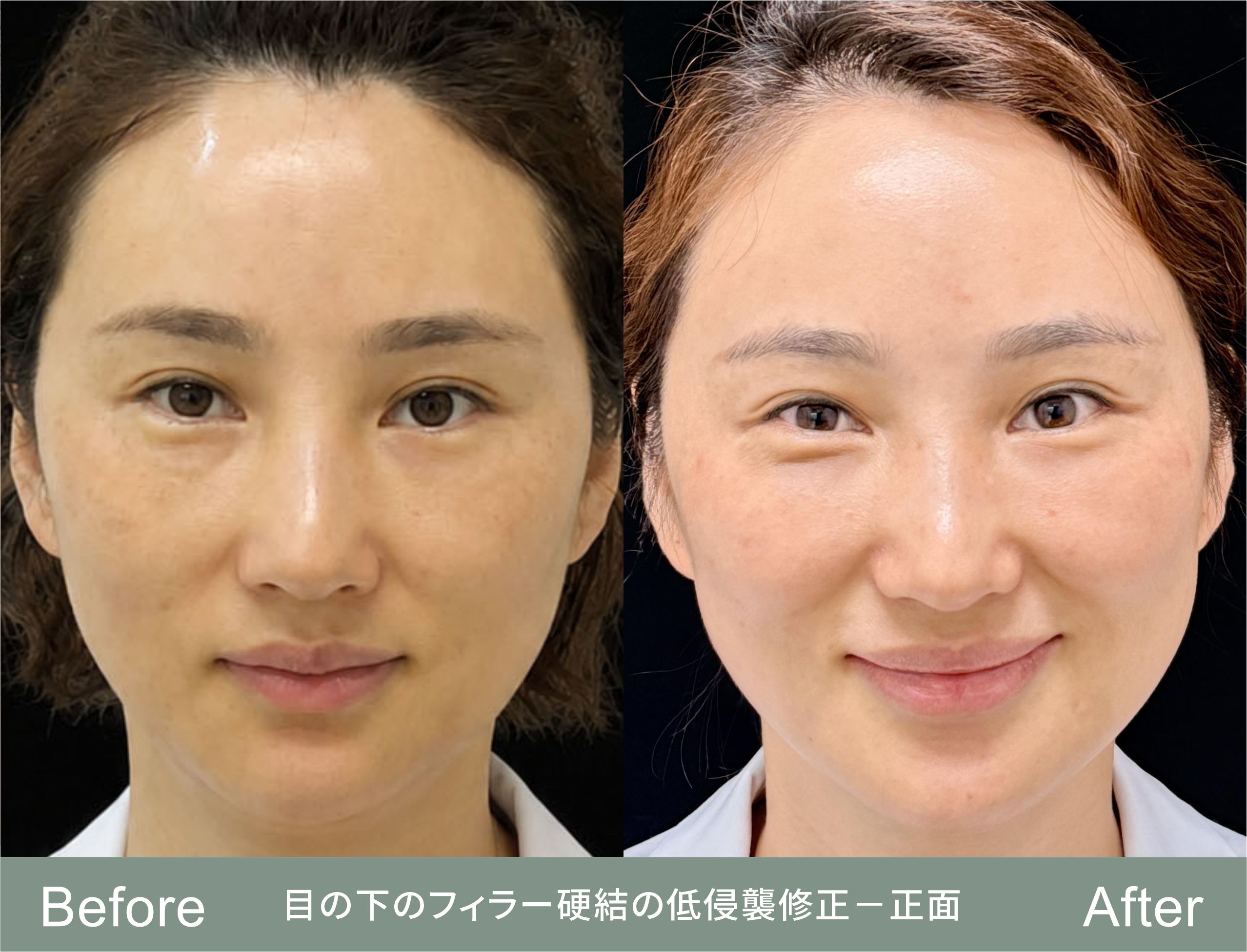 術前と術後3か月、同じ表情での目の下の輪郭の対比。この患者さんの悩みはまさに笑ったときに二つの塊が押し出されて目立つことだったので、どちらも笑顔で撮影しています。(ご本人の同意を得て共有、画像は匿名化済み。回復には個人差があります。)