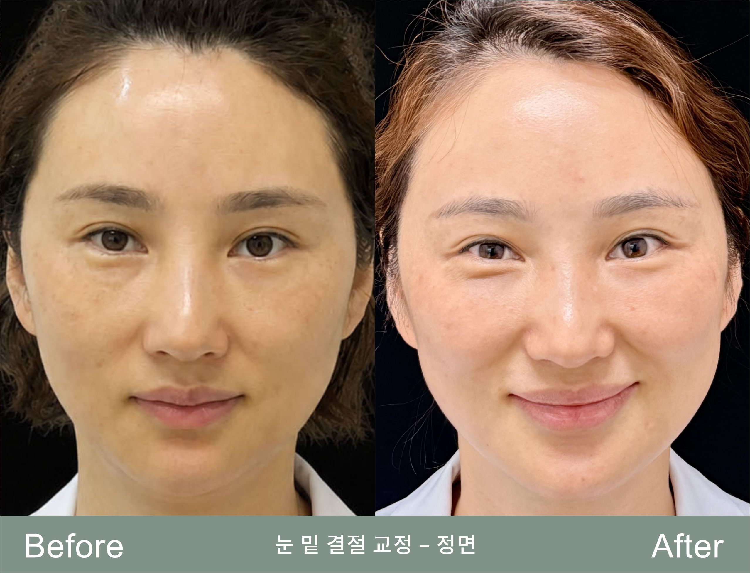 시술 전과 3개월 후, 같은 표정에서의 눈밑 윤곽 대비. 이 환자의 고민이 바로 웃을 때 두 멍울이 밀려 나와 도드라지는 것이었기에 두 장 모두 웃는 표정으로 촬영했습니다. (환자 동의 하에 공유하며 이미지는 비식별화되었습니다. 회복은 개인마다 다릅니다.)