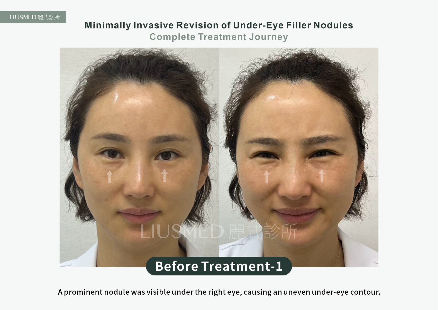 Before - Fat Graft, Then a Collagen Stimulator: Two Stacked Under-Eye Nodules Removed Through a Pinhole