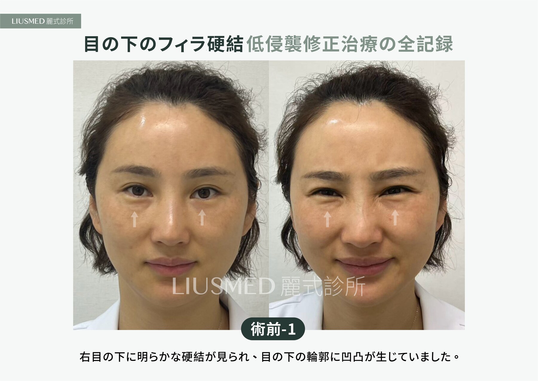 Before - 目の下の脂肪注入でしこり、さらに刺激剤でもう一つ——5年越しの二層のしこりを超音波で位置決めし針穴から摘出