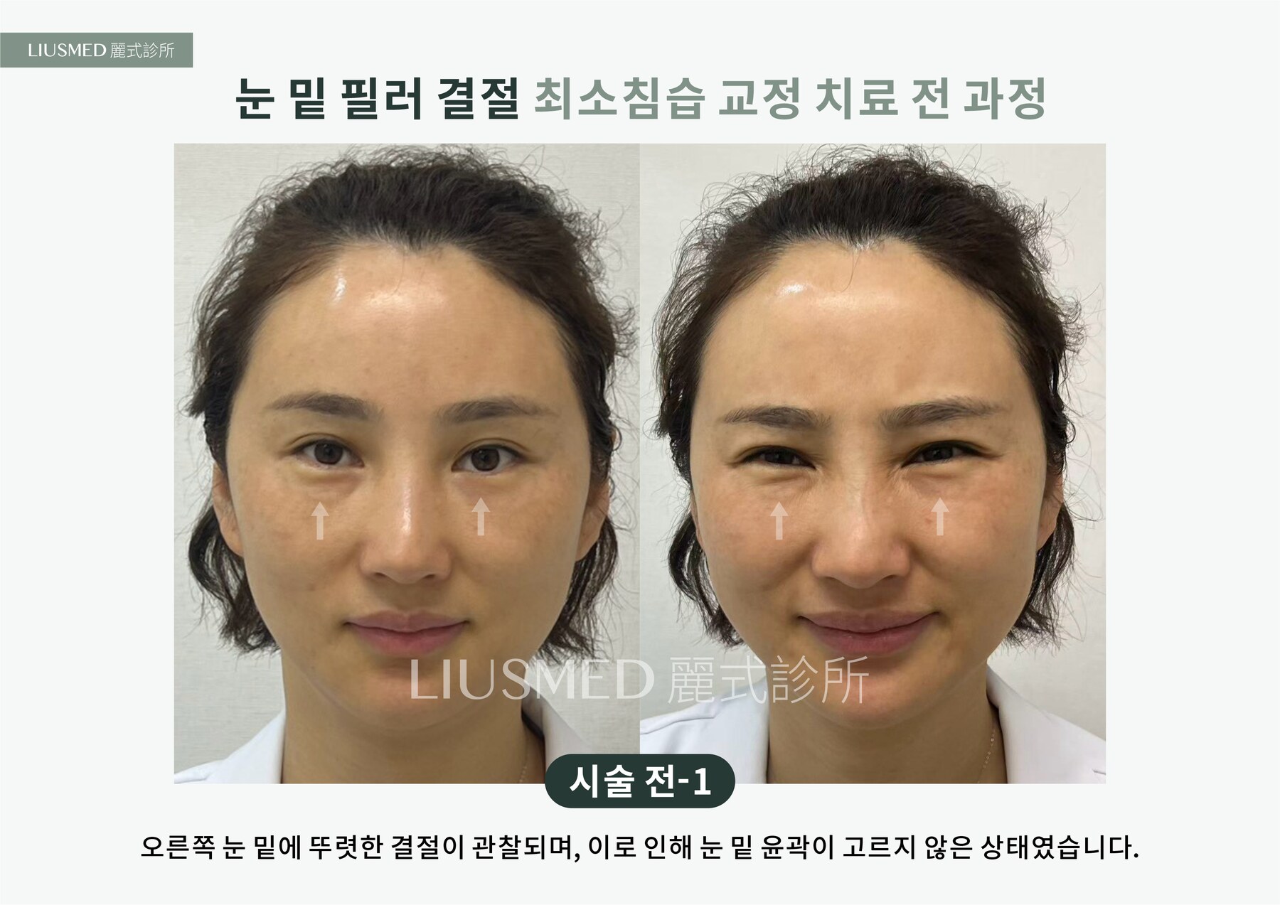 Before - 눈밑 지방이식 멍울, 다시 자극제로 또 하나——5년 된 이중 멍울을 초음파로 확인 후 바늘구멍으로 제거