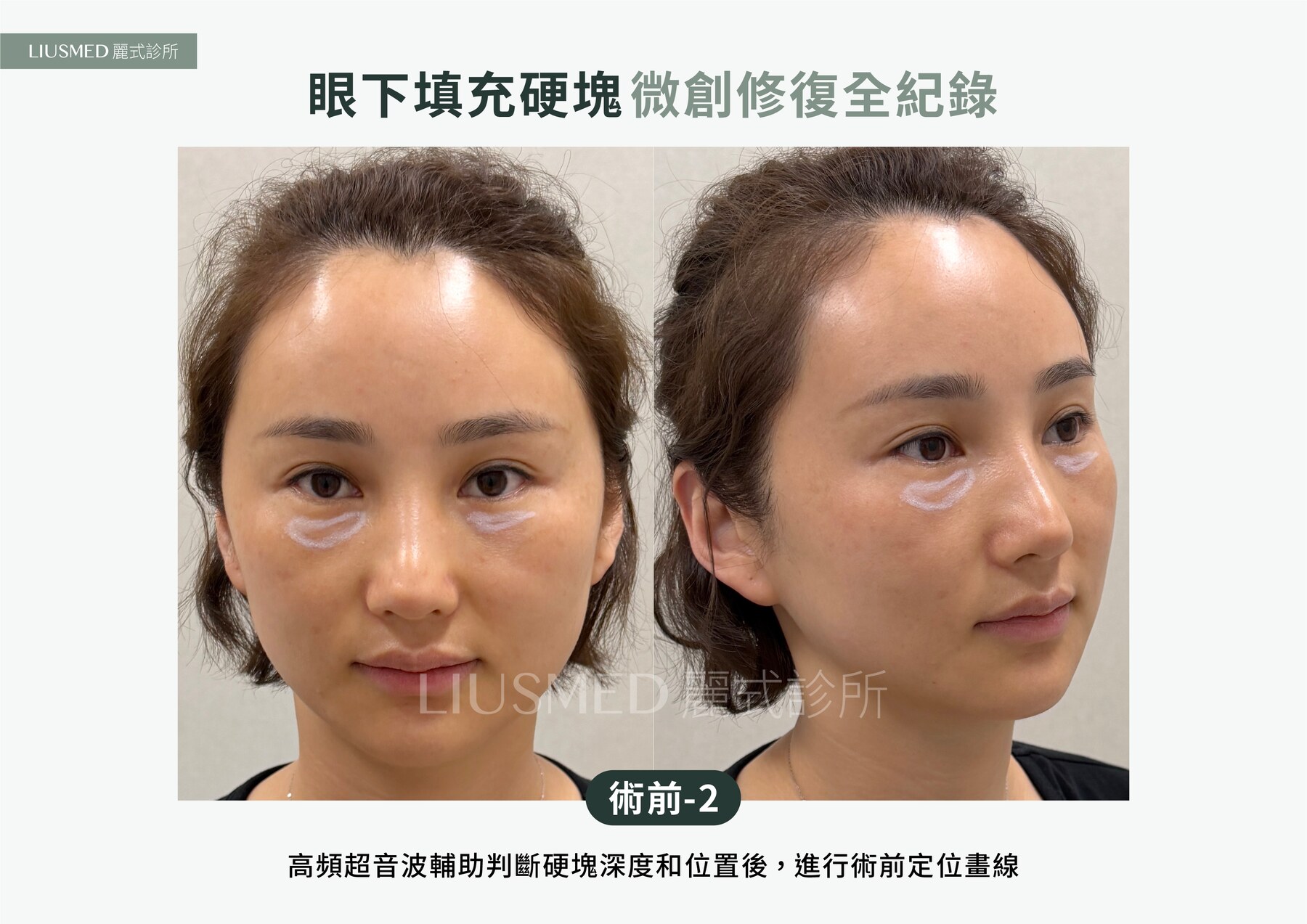 Ultrasound - 眼下補脂結塊、再補增生劑又一塊——五年雙層硬塊，超音波定位後針孔取出