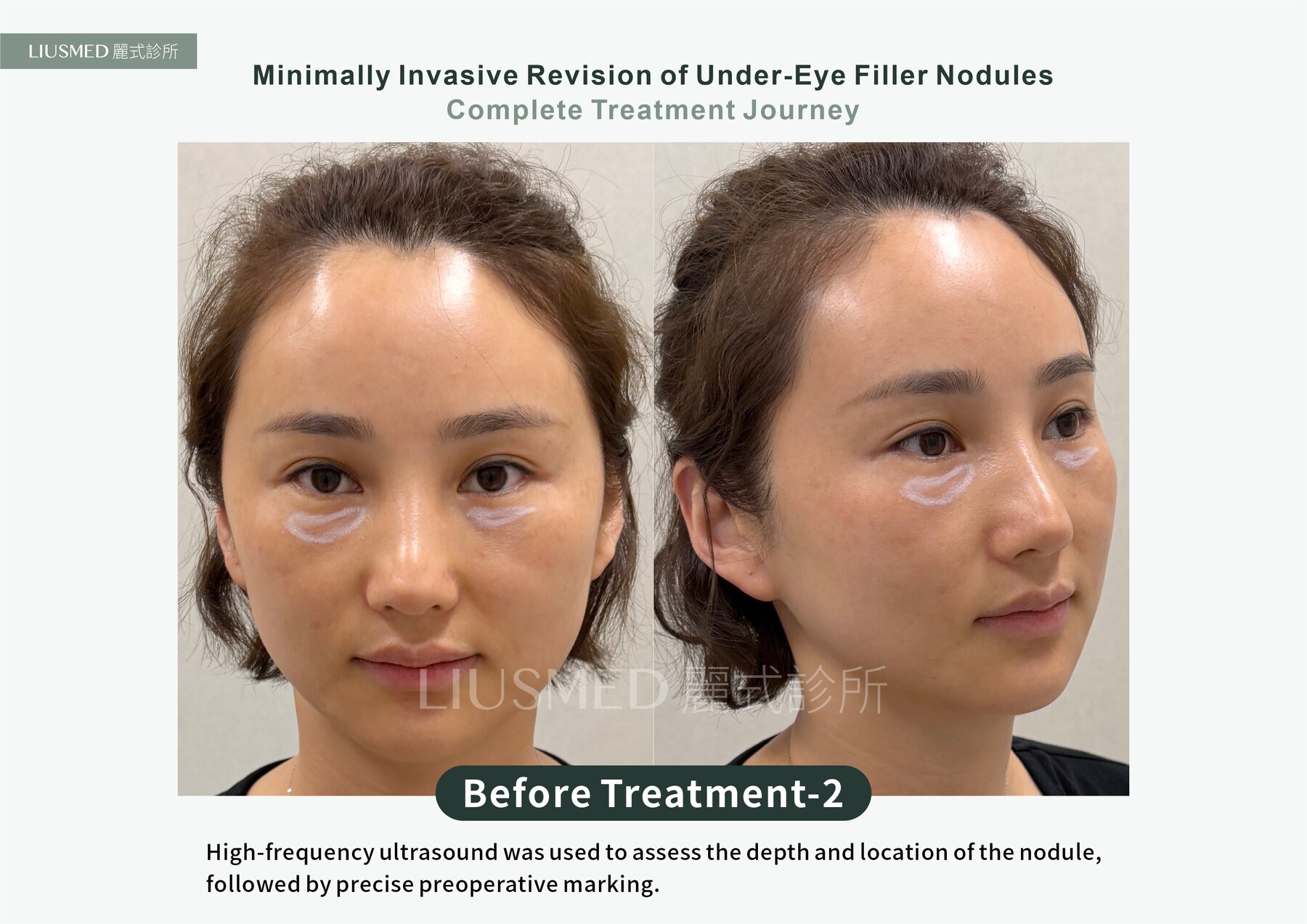 Ultrasound - Fat Graft, Then a Collagen Stimulator: Two Stacked Under-Eye Nodules Removed Through a Pinhole