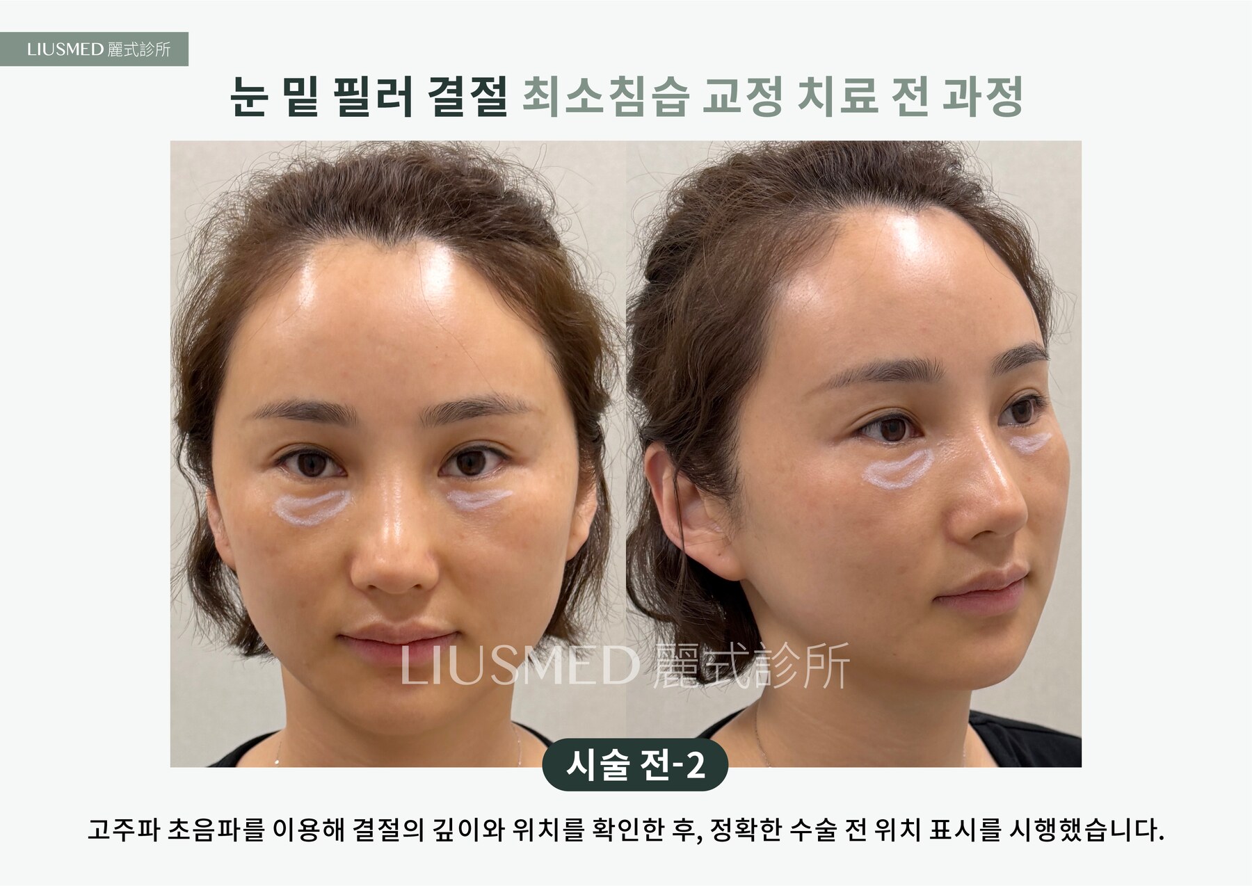 Ultrasound - 눈밑 지방이식 멍울, 다시 자극제로 또 하나——5년 된 이중 멍울을 초음파로 확인 후 바늘구멍으로 제거