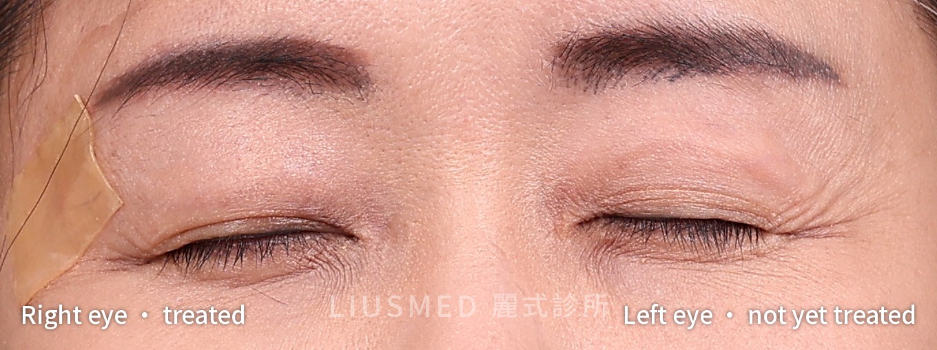 After — Upper Eyelids Bulging After a Fat Graft: Waiting Won't Shrink It and Nothing Dissolves It — Why Remove It in Stages, One Side First