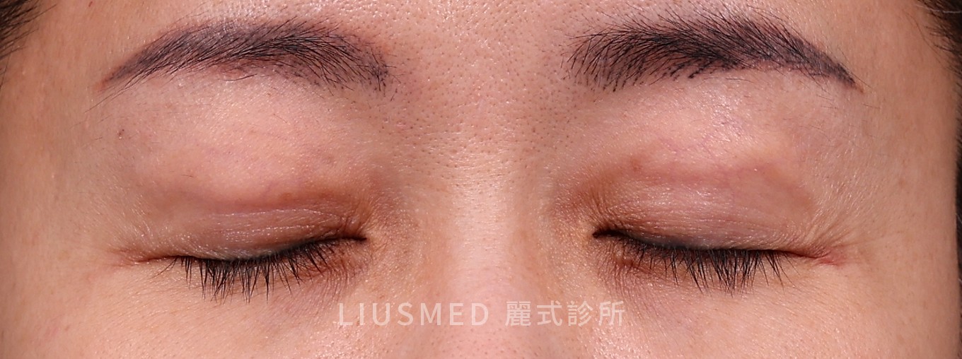 術前 — 上眼皮補脂後越來越凸：等不會消、溶不掉，為什麼分次取、先做一邊