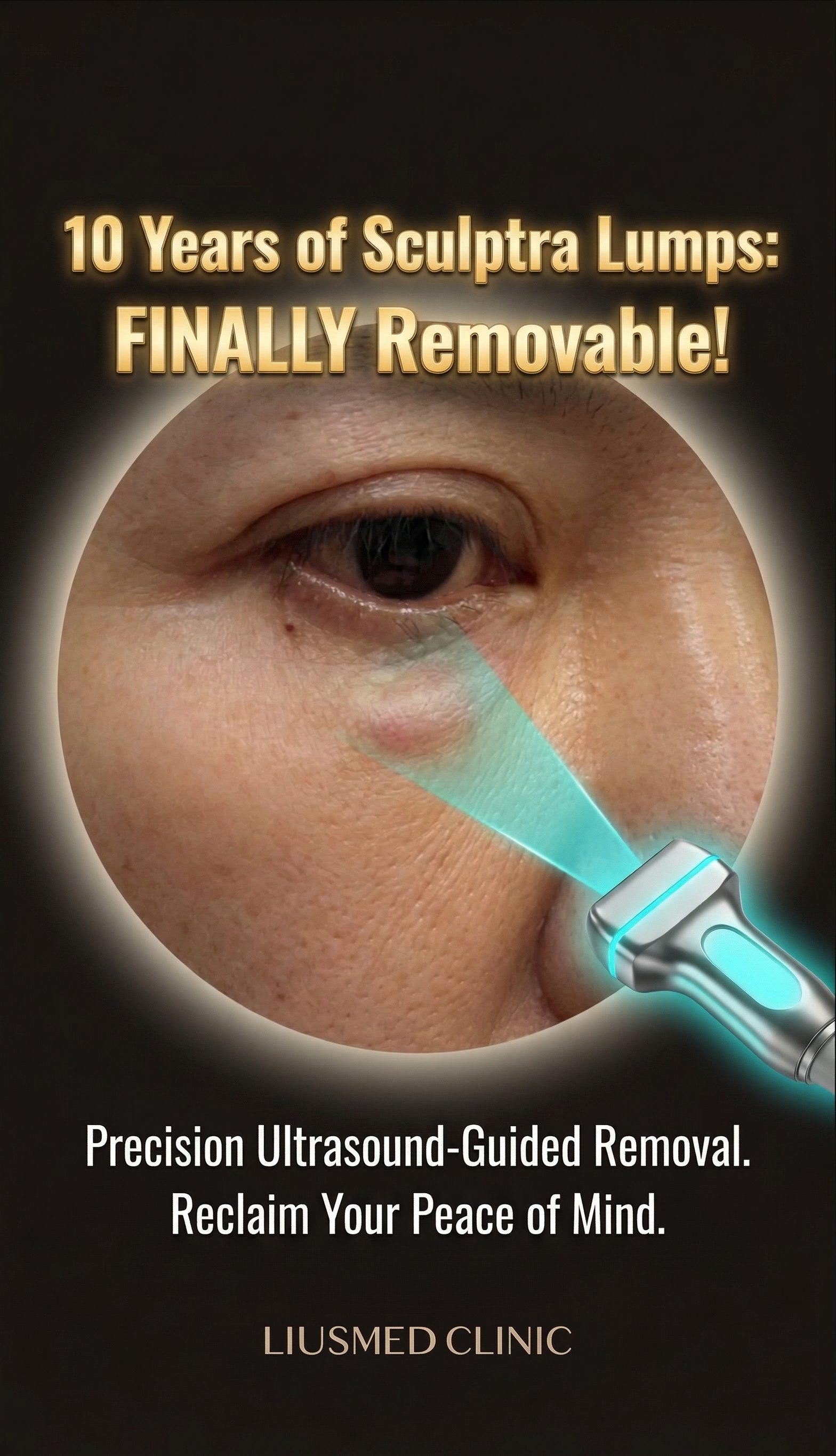 10 Years Under the Eyes: Ultrasound-Guided Removal of a Sculptra Lump