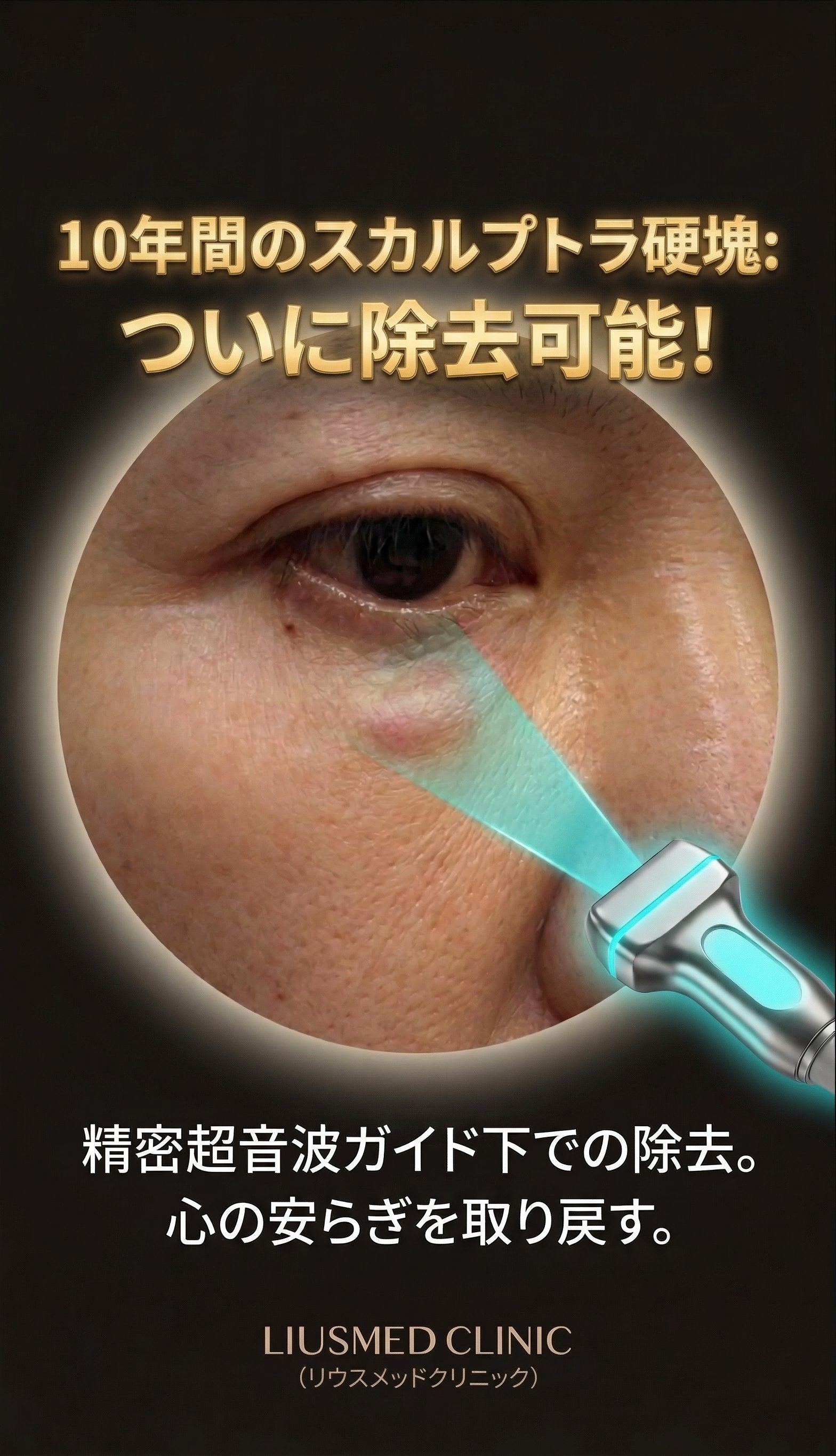 目の下に10年残った不安：スカルプトラしこりの超音波ガイド下・低侵襲除去