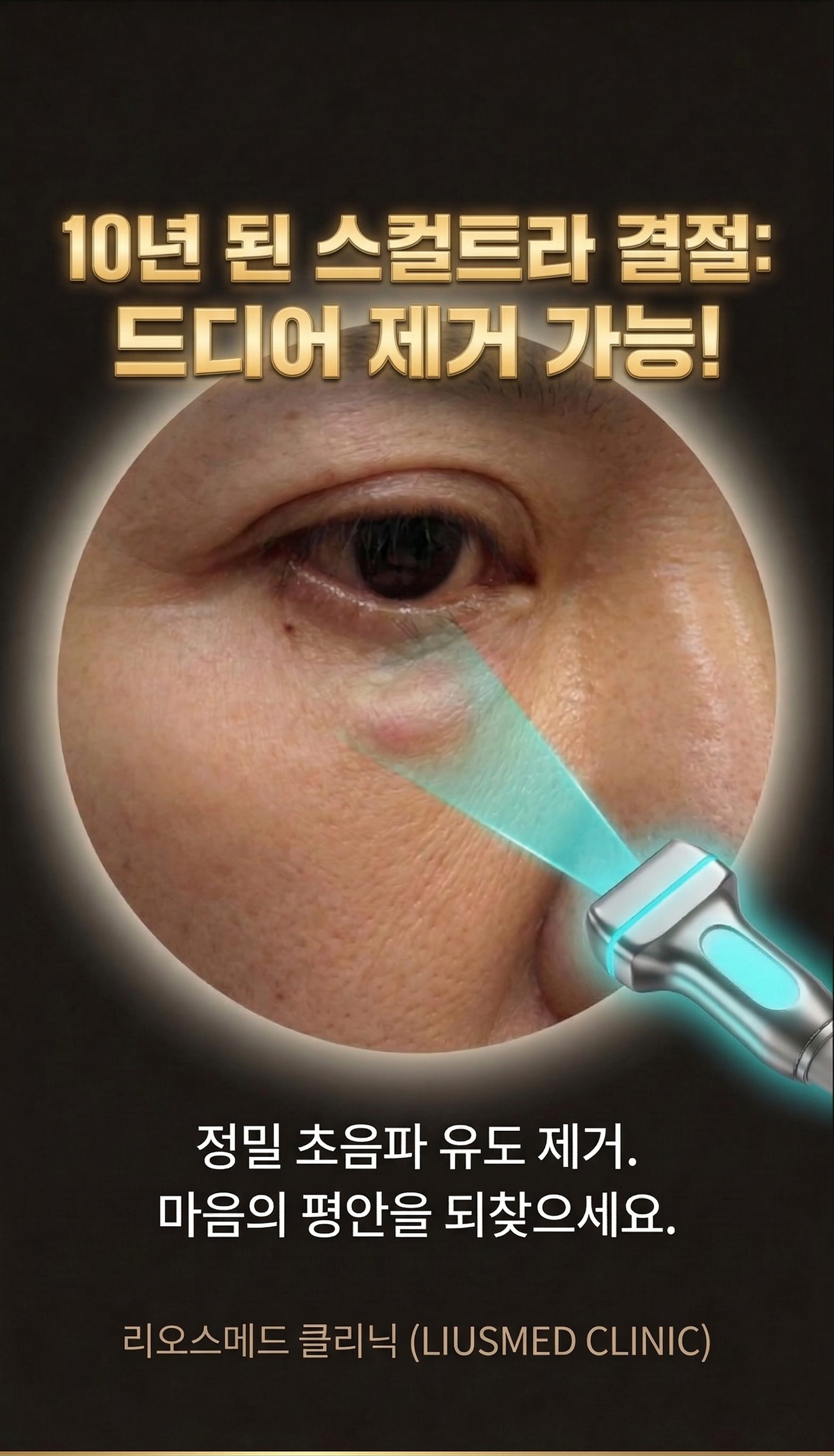 눈 밑에 남아 있던 10년의 불안: 스컬트라 결절의 초음파 유도 최소침습 제거