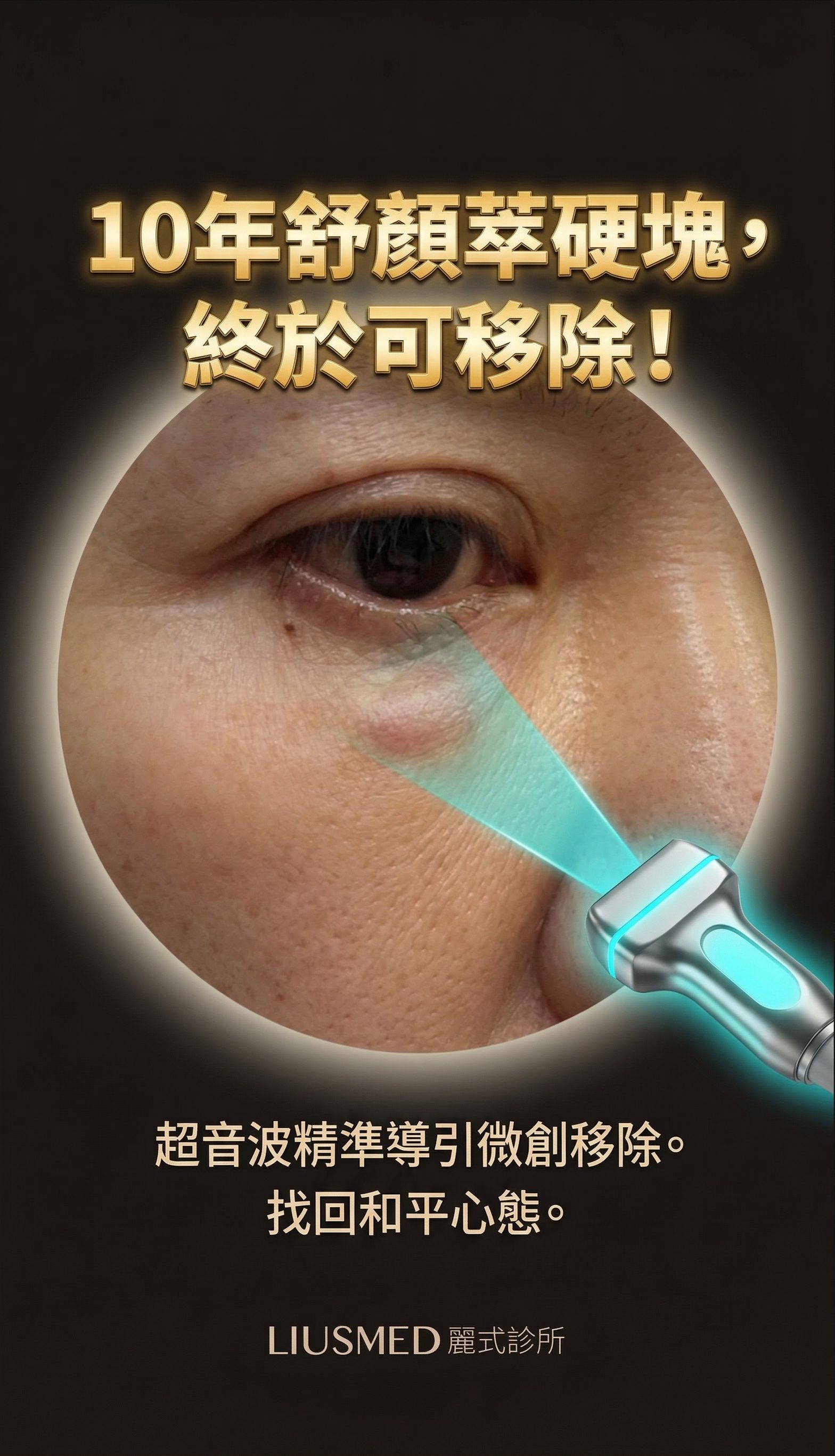 眼下10年的焦慮：舒顏萃硬塊的超音波引導微創取出