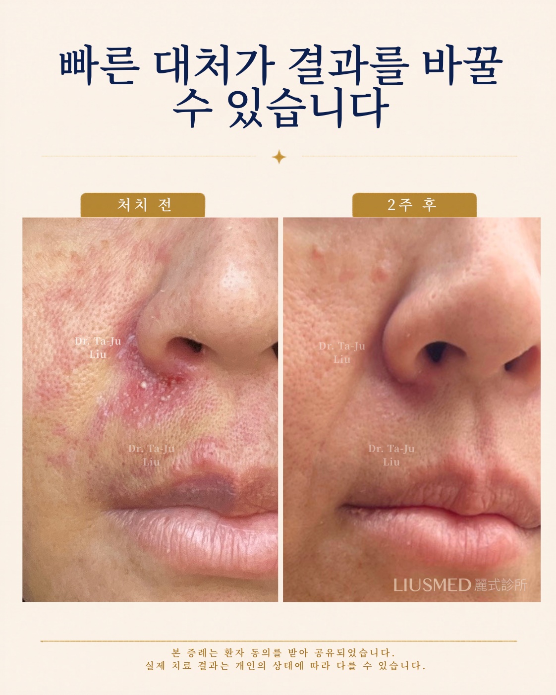 시간이 결정합니다. 즉각 조치가 결과를 바꿉니다