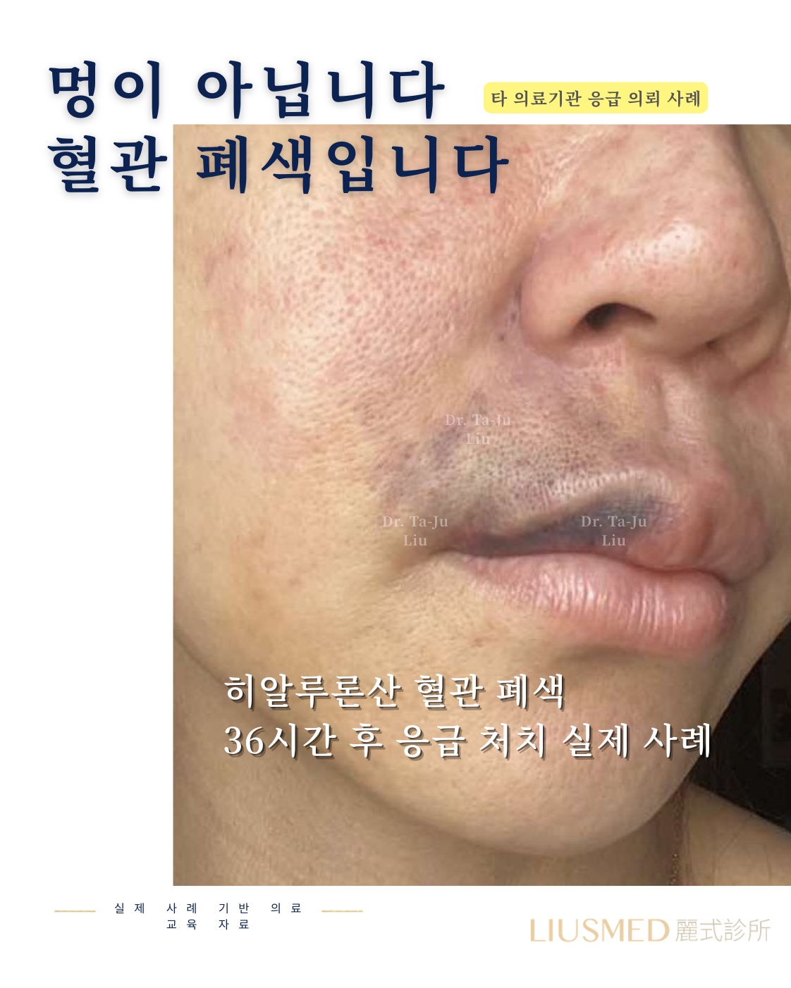 멍이 아닙니다. 혈관 색전입니다——36시간 구조 실록