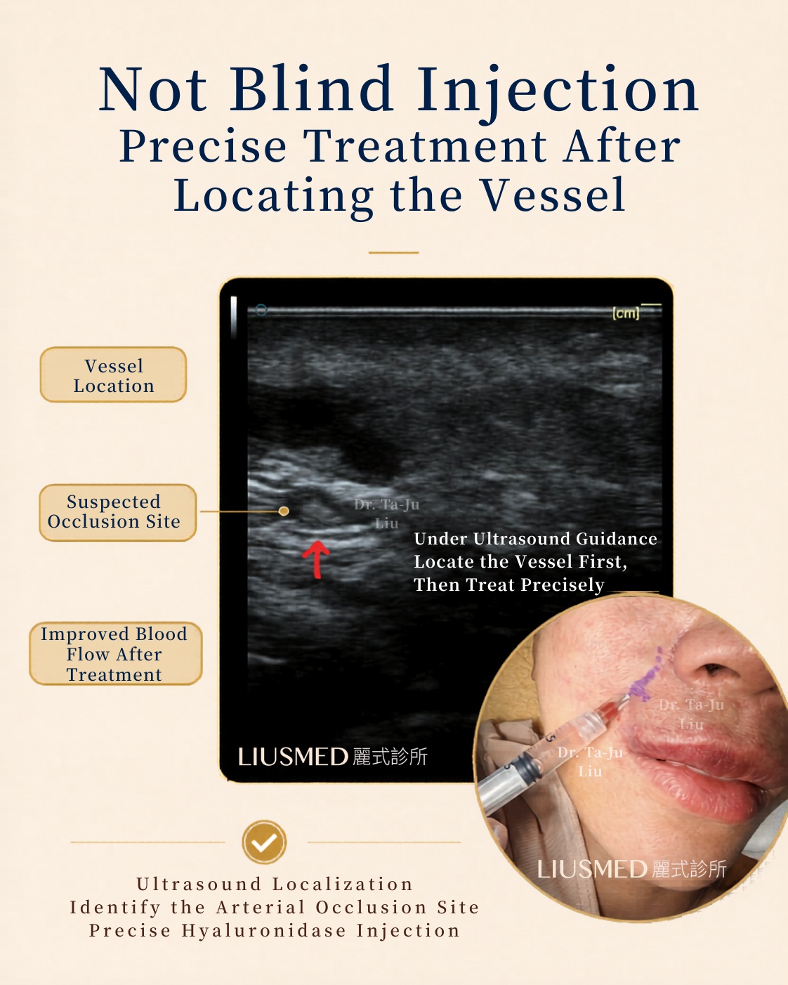 Not blind injection — find the vessel first, then treat precisely. — Under real-time ultrasound: localize the occlusion, then deliver intra-arterial hyaluronidase exactly where it's needed.