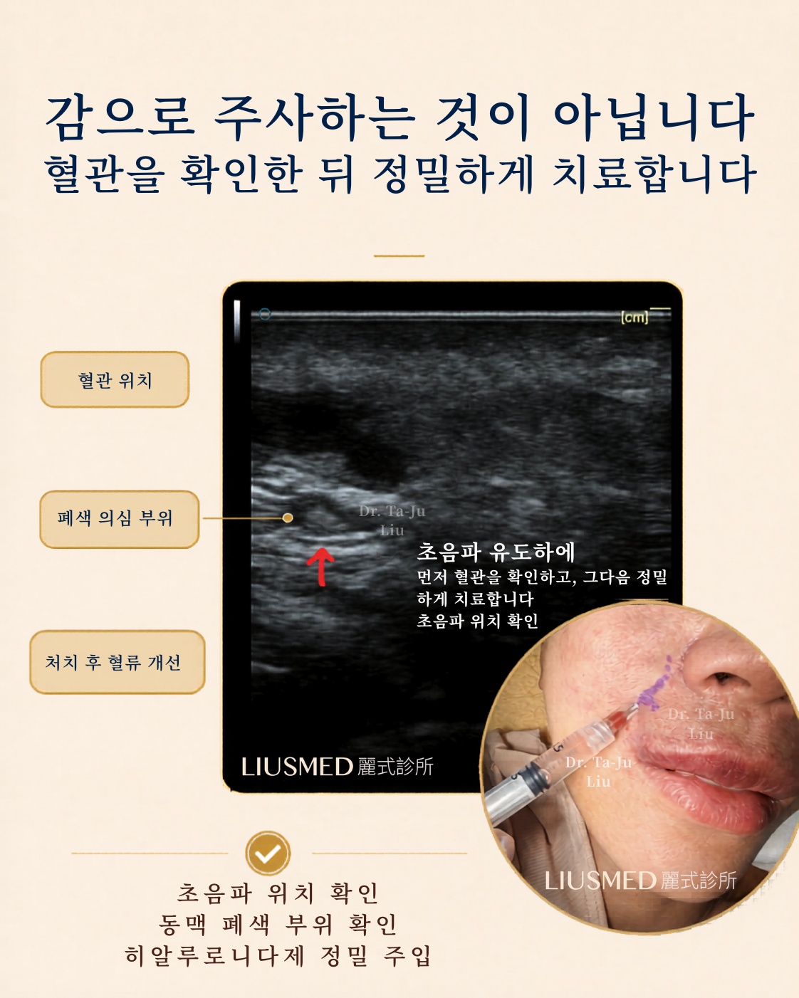 맹목 주사가 아닙니다. 혈관을 먼저 찾고 정밀하게 처치합니다. — 실시간 초음파 유도 하에: 먼저 혈관을 찾고, 그다음 정밀하게 처치. 동맥 내 히알루로니다아제(IAHA)를 필요한 곳에 정확히 주입.