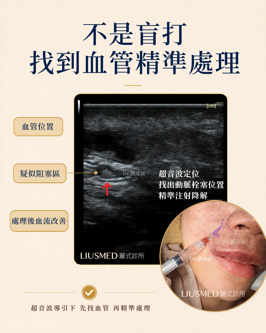 不是盲打 找到血管再精準處理 — 超音波導引下:先找血管、再精準處理。動脈內降解酶(IAHA)注射,直接溶解阻塞顏面動脈的玻尿酸。