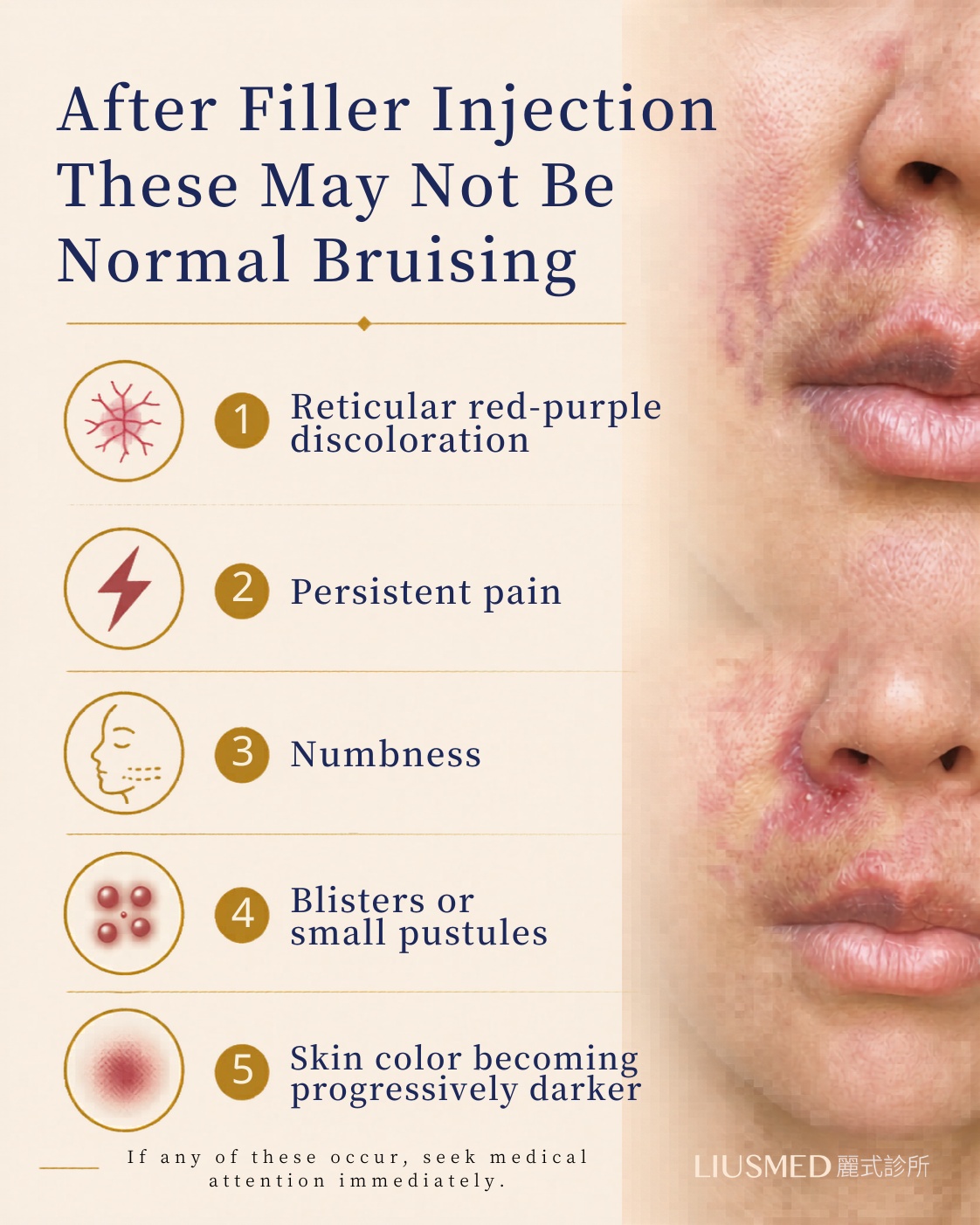 After filler: these may not be normal bruises