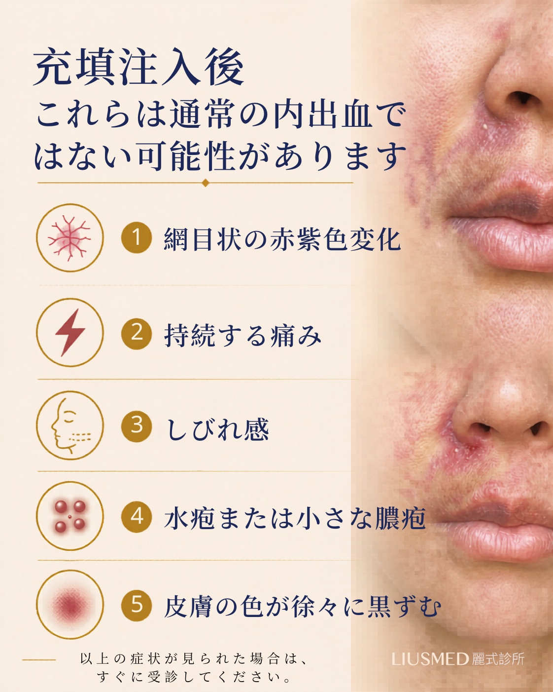 フィラー注入後、これは普通の打撲ではないかも