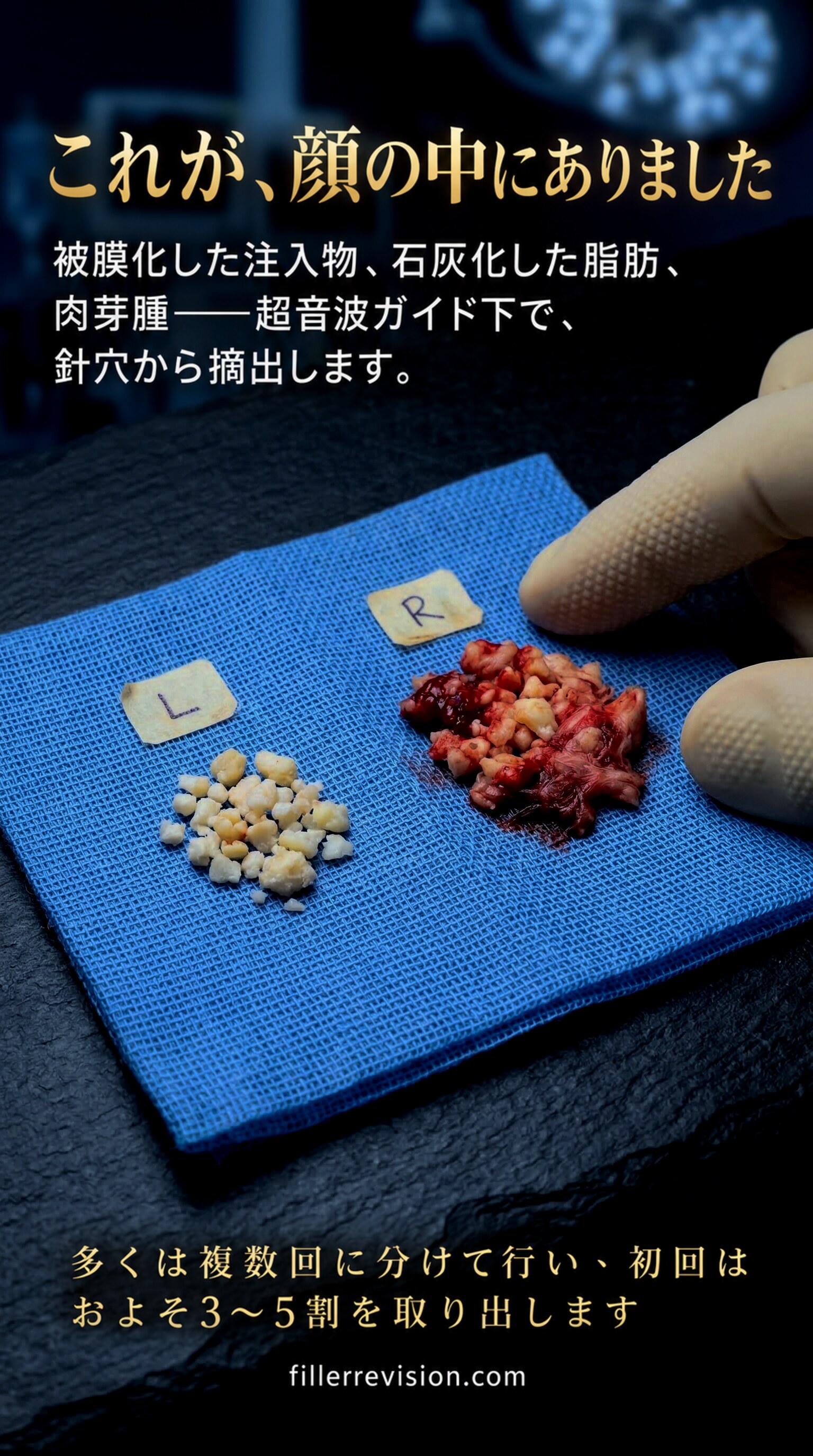 これが、顔の中にありました — 被膜化した注入物、石灰化した脂肪、肉芽腫――超音波ガイド下で、針穴から摘出します。多くは複数回に分けて行い、初回はおよそ3〜5割を取り出します。