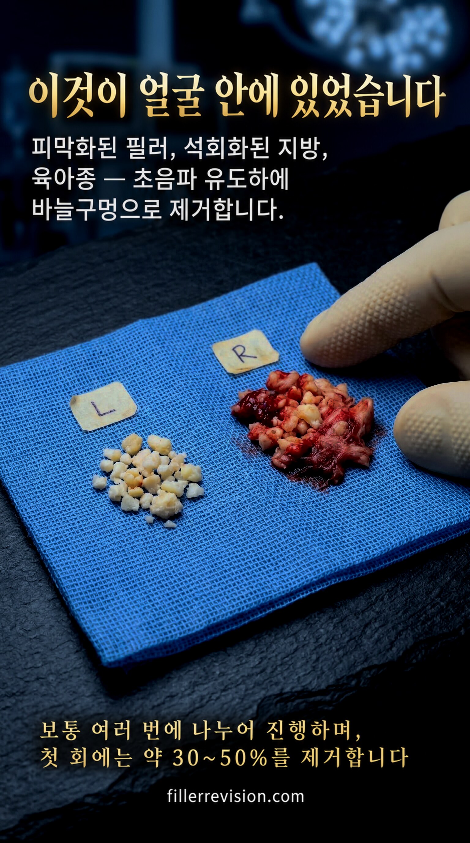 이것이 얼굴 안에 있었습니다 — 피막화된 필러, 석회화된 지방, 육아종 — 초음파 유도하에 바늘구멍으로 제거합니다. 보통 여러 번에 나누어 진행하며, 첫 회에는 약 30~50%를 제거합니다.