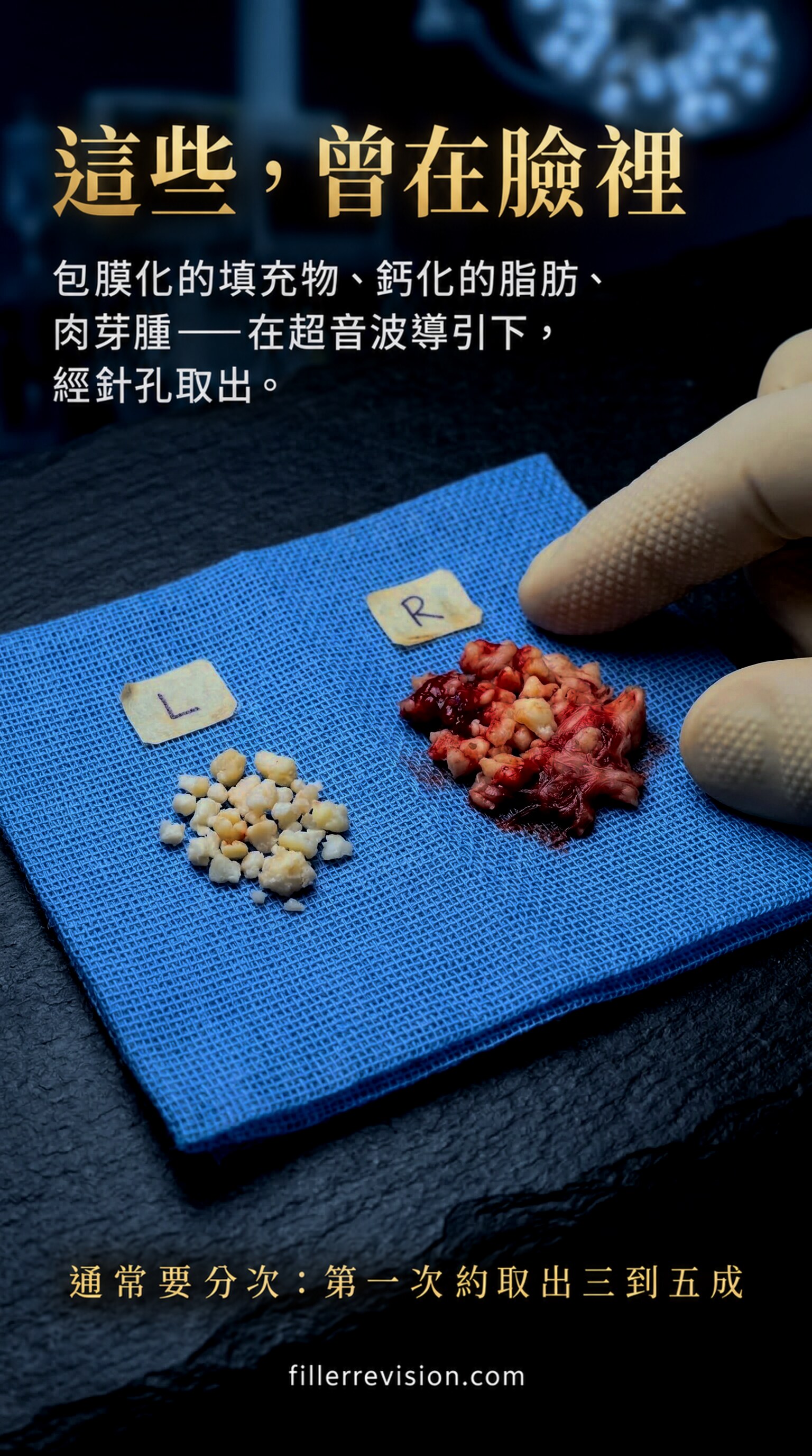 這些,曾在臉裡 — 包膜化的填充物、鈣化的脂肪、肉芽腫——在超音波導引下,經針孔取出。通常要分次:第一次約取出三到五成。