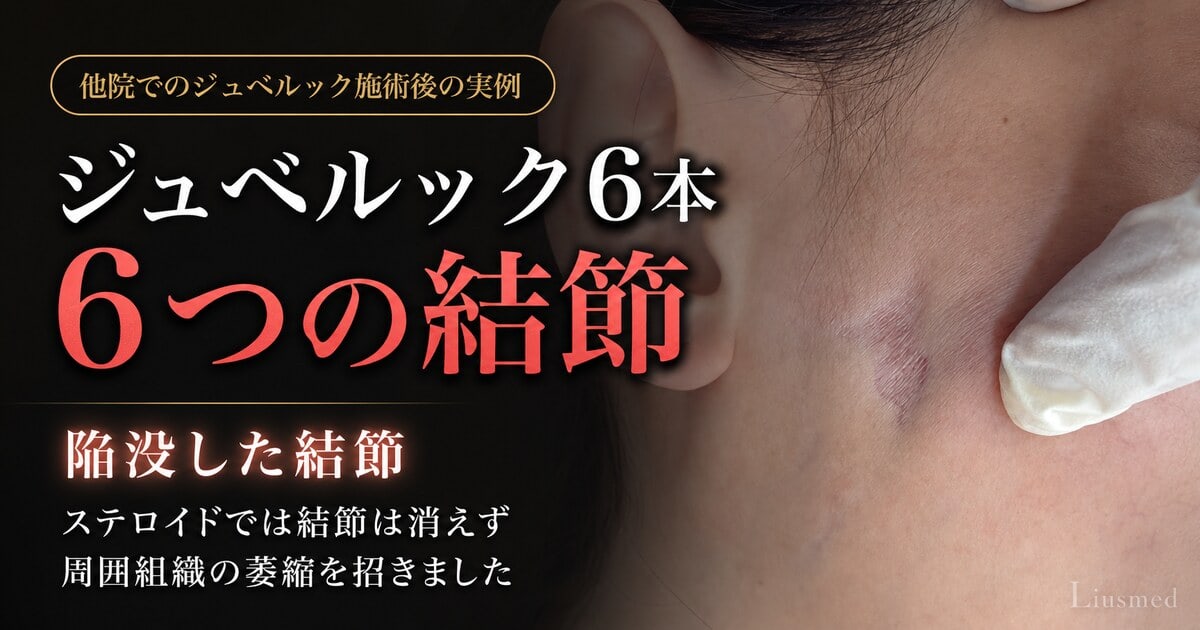 ジュベルック結節の症例動画サムネイル——ステロイド注射を受けた耳前部の陥没した結節。ステロイドは結節を消さず、周囲組織を萎縮させた