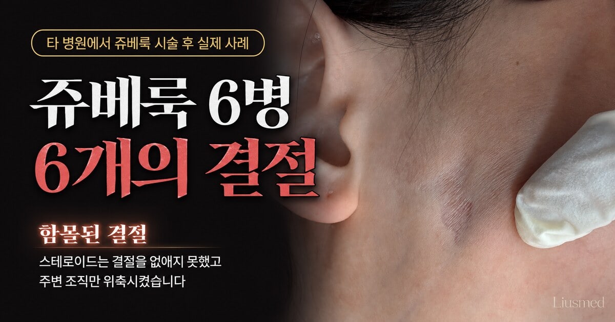 쥬베룩 결절 사례 영상 표지 — 스테로이드를 주사한 귀 앞쪽의 함몰된 결절. 스테로이드는 결절을 없애지 못하고 주변 조직을 위축시켰다