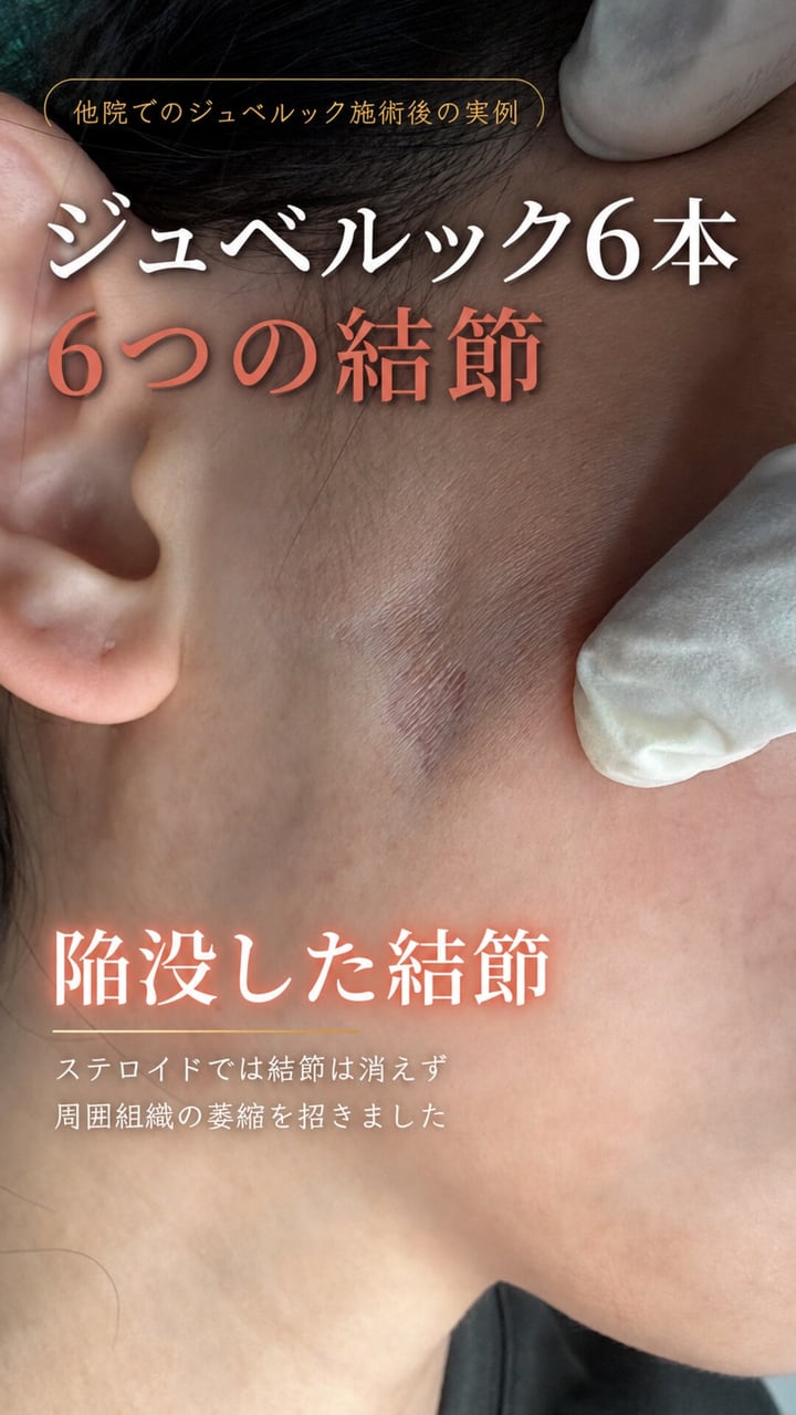 ジュベルック結節の症例動画サムネイル——ステロイド注射を受けた耳前部の陥没した結節。ステロイドは結節を消さず、周囲組織を萎縮させた