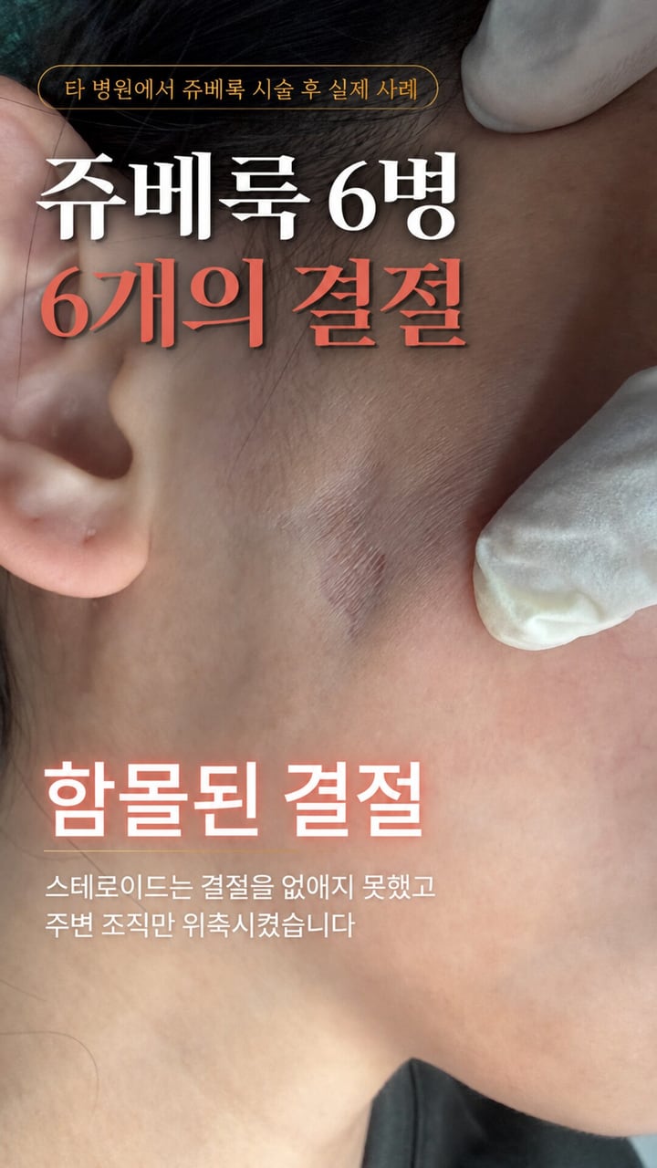 쥬베룩 결절 사례 영상 표지 — 스테로이드를 주사한 귀 앞쪽의 함몰된 결절. 스테로이드는 결절을 없애지 못하고 주변 조직을 위축시켰다