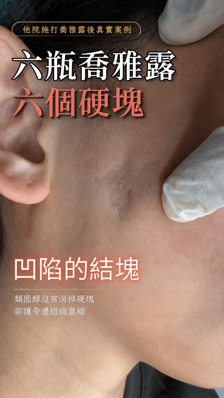喬雅露硬塊案例影片封面——耳前打過類固醇的那一處凹陷結節，類固醇沒有消掉硬塊、卻讓旁邊組織萎縮