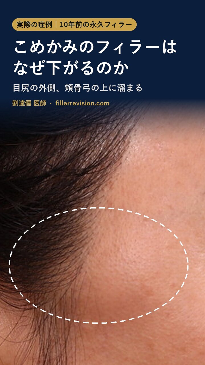 こめかみのフィラーが下がった実際の症例動画のサムネイル：10年前の永久フィラーが頬骨弓の上、目尻の外側に溜まり、点線で示している