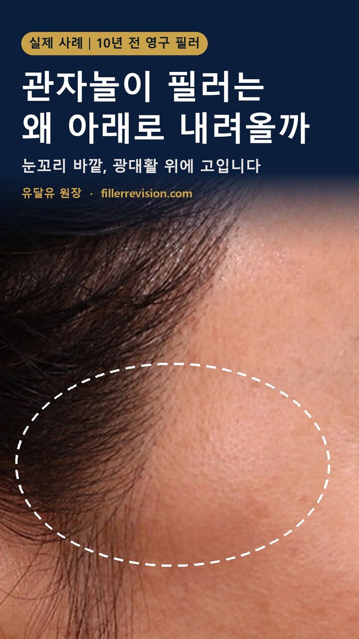 관자놀이 필러가 아래로 내려온 실제 사례 영상 표지: 10년 전 영구 필러가 광대활 위, 눈꼬리 바깥쪽에 고여 있고 점선으로 표시했다