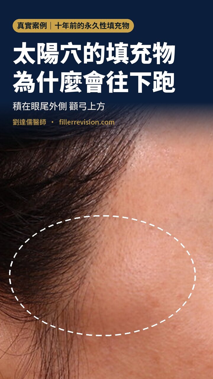 太陽穴填充物往下跑的真實案例影片封面：十年前打的永久性填充物積在顴弓上方、眼尾外側，虛線標出積聚處