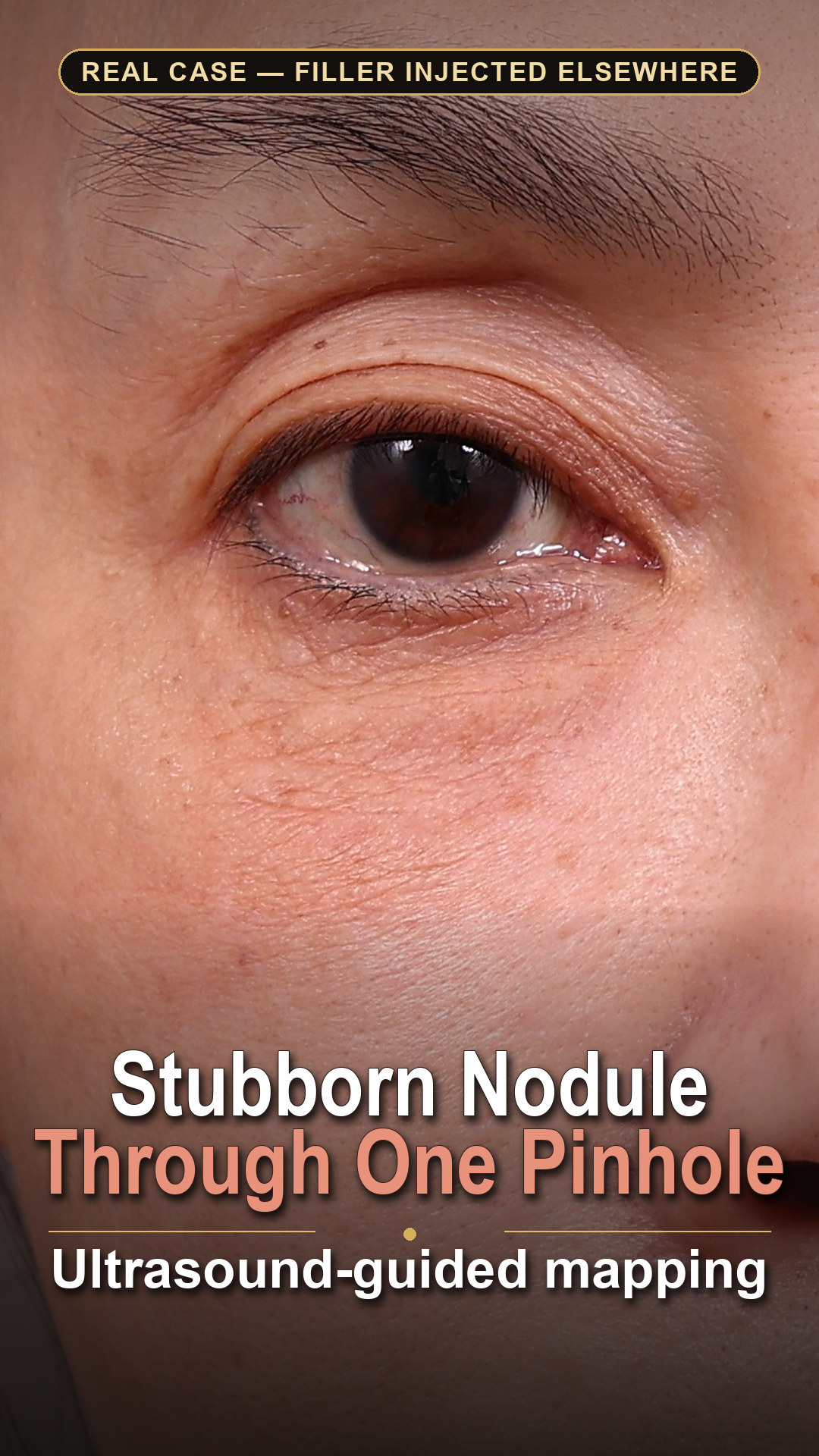 Under-eye nodule case video cover — pre-op close-up of a stubborn filler nodule below the right eye, removed through a single ultrasound-guided pinhole