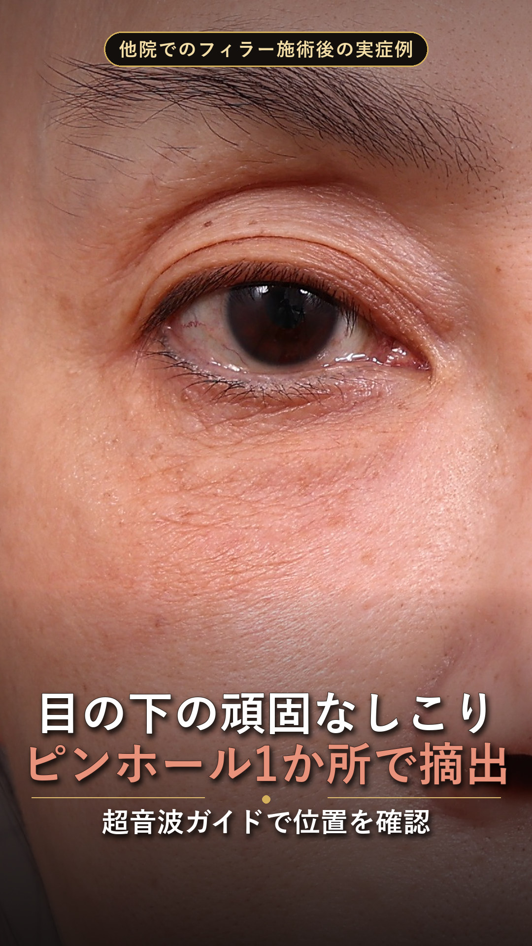 目の下の結節症例動画のサムネイル——右目の下にできた頑固なフィラー結節の術前クローズアップ。超音波ガイド下の1か所のピンホールから摘出