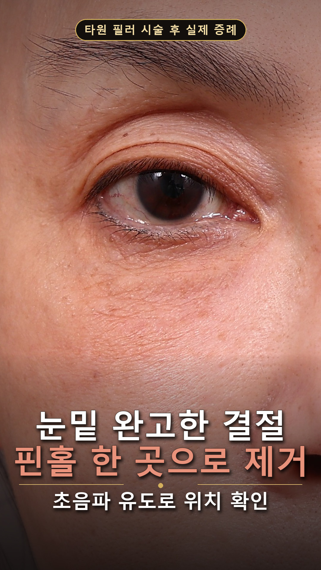 눈밑 결절 사례 영상 표지 — 오른쪽 눈 아래 완고한 필러 결절의 수술 전 클로즈업. 초음파 유도 핀홀 한 곳으로 제거