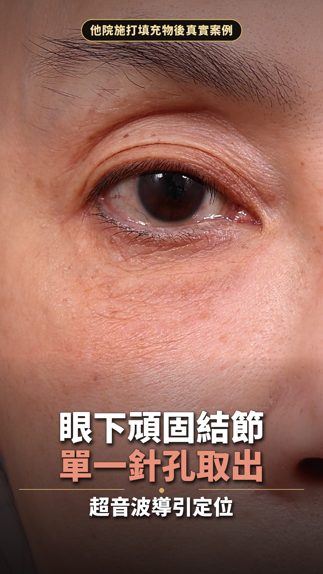 眼下結節案例影片封面——右眼下方頑固填充物結節的術前特寫，以超音波導引單一針孔取出